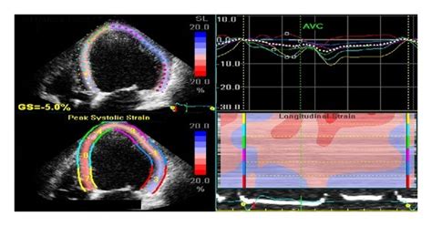 Examples Of Strain Imaging Using Speckle Tracking Echocardiography On