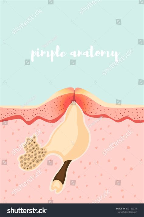 Anatomical Structure Pimple Vector Illustration Human Stock-vektor ...