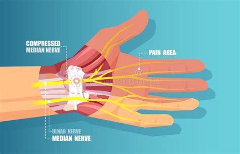 Vector Of A Carpal Tunnel Syndrome With Median Nerve Compression Stock