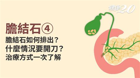 膽結石／膽結石一定要開刀嗎？膽囊切除會怎樣？1療法疼痛消失不復發治療藥物改善