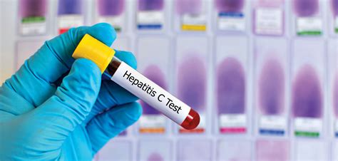 U.S. Looks to Implement One-Step Hepatitis C Diagnosis - Hep