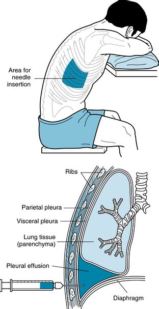 Thoracentesis Positioning