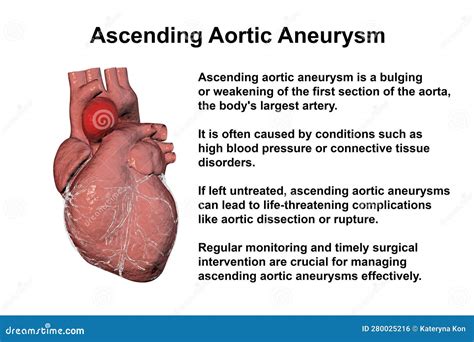 Thoracic Aortic Aneurysm Diagnosis And Treatment Mayo 51 OFF