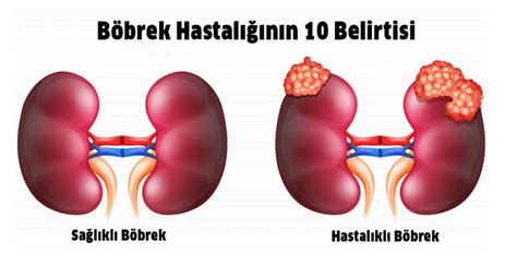 İşte Böbrek Hastalığının 10 Belirtisi