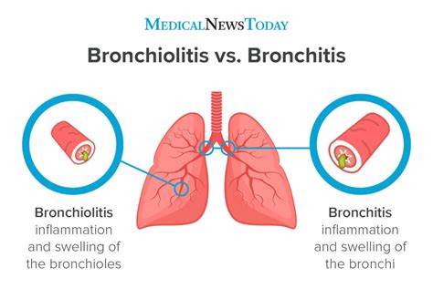 Bronchiolitis Vs Bronchitis Whats The Difference