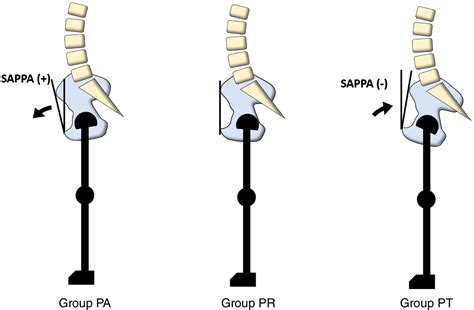 Influence Of Spinopelvic Alignment On Pelvic Tilt After Total Hip