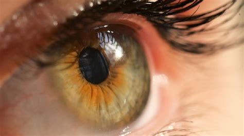 3 Características Del Colesterol Alto En Los Ojos Cuidado Con La