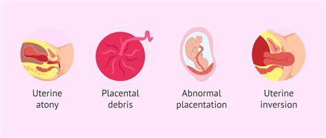 Causes Of Post Partum Haemorrhage