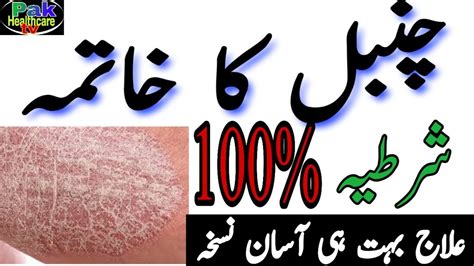 Chambal Ka Mukammal Khatma Aur Muft Ilaj Kare Psoriasis Treatment In