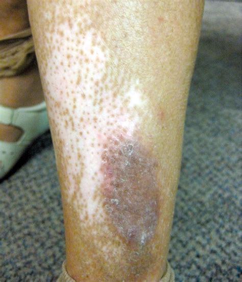 Fungal Dermatitis