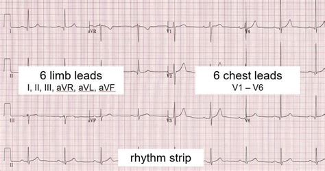 Ecg Rhythm Strip