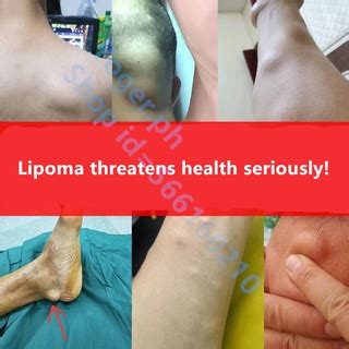 20g/box Lipoma Removal Ointment Treatment For Lipoma Lipomatosis ...