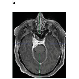 A Preoperative Axial T1 Weighted Sequence With Gadolinium Enhancement