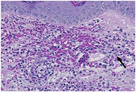 Skin Biopsy Showed Massive Neutrophilic Infiltrate In Soft Tissue