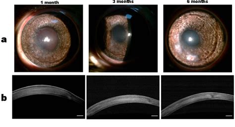 Figure 1 From Corneal Stroma Regeneration With Collagen Based Hydrogel