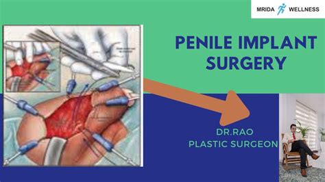 Penile Implant Review By Patient Youtube