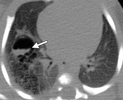 Airp Best Cases In Radiologic Pathologic Correlation Type 2 Congenital Cystic Adenomatoid