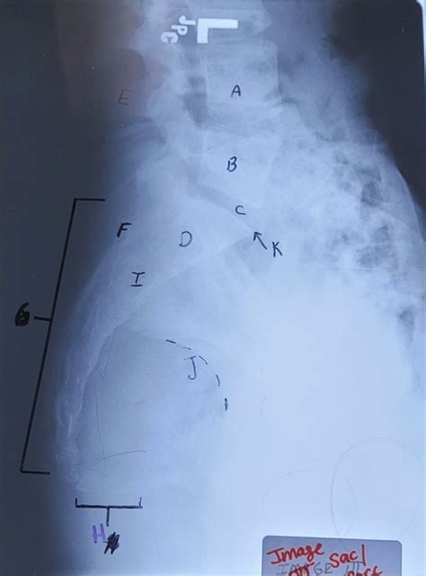 Sacrum And Coccyx Lat Diagram Quizlet