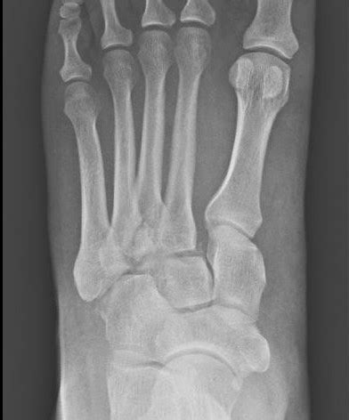 Lisfranc Fracture Dislocation - Premier Radiology Services