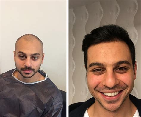 Hair Transplant Before After Photos In Turkey Influential Results