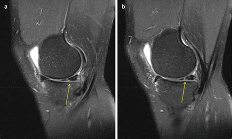 Meniscal Lesions From Basic Science To Clinical Management In