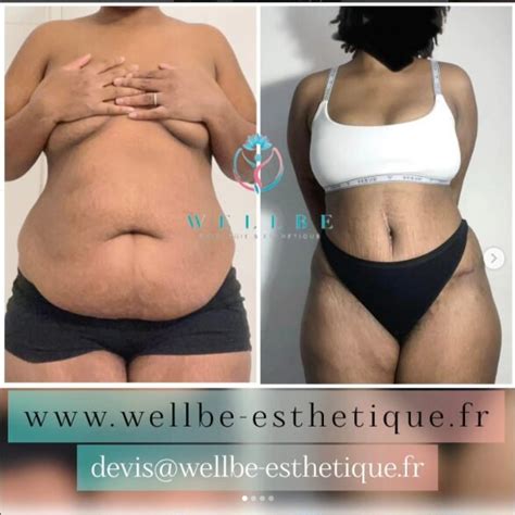 Chirurgie Esth Tique Tunisie Prix Doux Wellbe Esth Tique