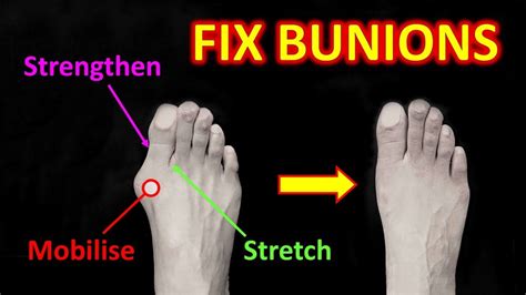 How To Fix Bunions The 4 Most Effective Exercises And 3 Causes Youtube