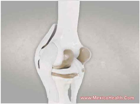 Meniscus Repair Surgery In Tijuana Mexico Mexico Health