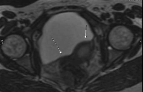 Hematometra with hematosalpinx-MRI - Sumer's Radiology Blog