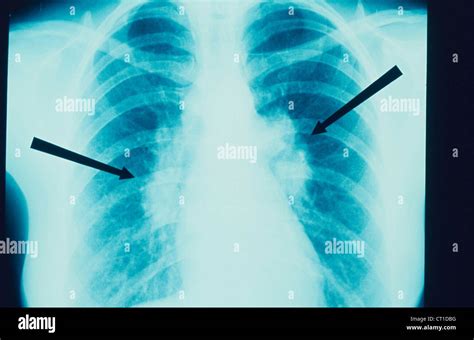 Lung sarcoidosis hi-res stock photography and images - Alamy