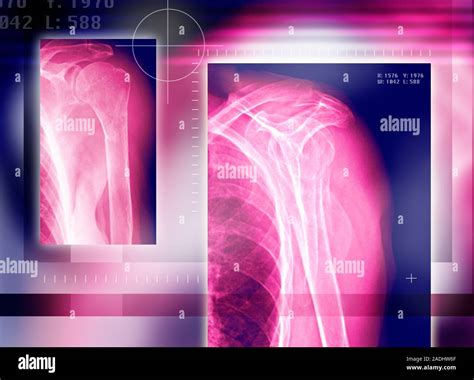 Broken Collar Bone Coloured Frontal X Ray Of A Patient With A