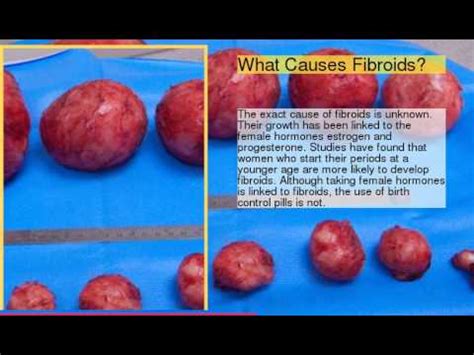 uterine fibroid size chart Comparing fibroids with fruits