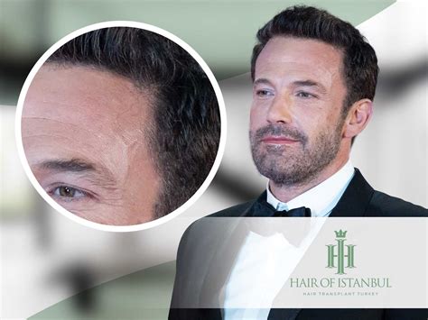 Ben Affleck Hair Transplant What Is The Story Behind