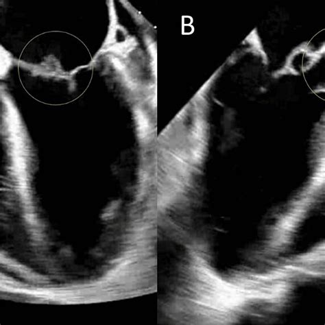 Vegetations Of The Mitral Valve In Picture A And Aortic Valve In Download Scientific Diagram