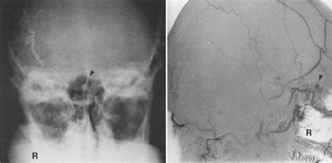 [pdf] Ruptured Berry Aneurysm Of The Anterior Ethmoidal Artery Associated With Bilateral