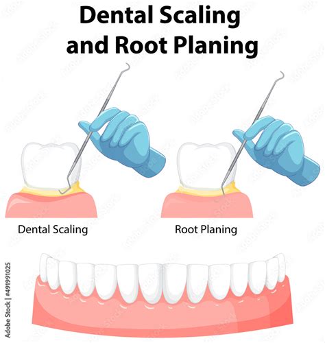 Infographic Of Human In Dental Scaling And Root Planing Stock Vector