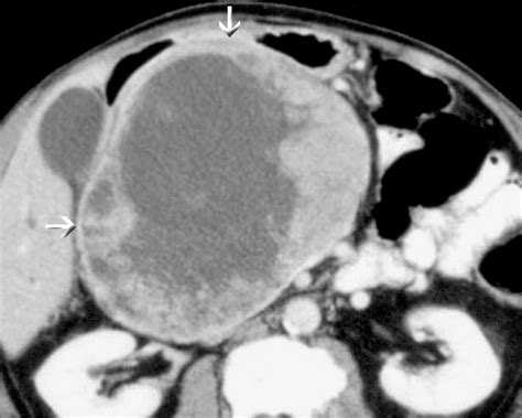 Ct And Mri Features Of Pure Acinar Cell Carcinoma Of The Pancreas In