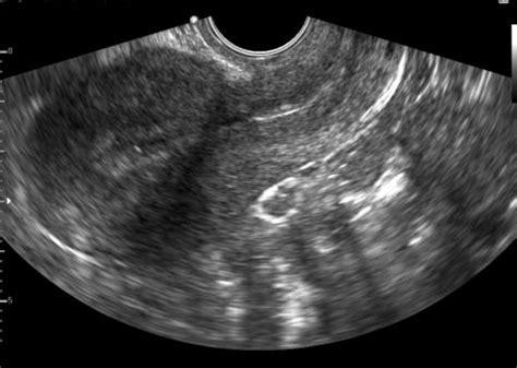 Normal Transvaginal Ultrasound The Uterus Is The Large 70308 Hot Sex