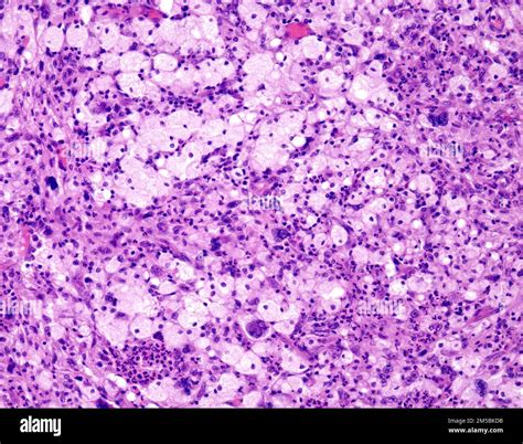 Undifferentiated Pleomorphic Sarcoma Light Micrograph