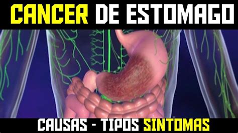 Sintomas De Cancer De Estomago