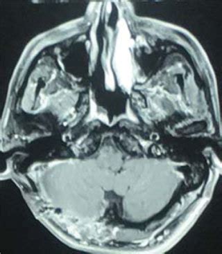 Postoperative Mri Of The Brain At Month Follow Up Showed No Residual