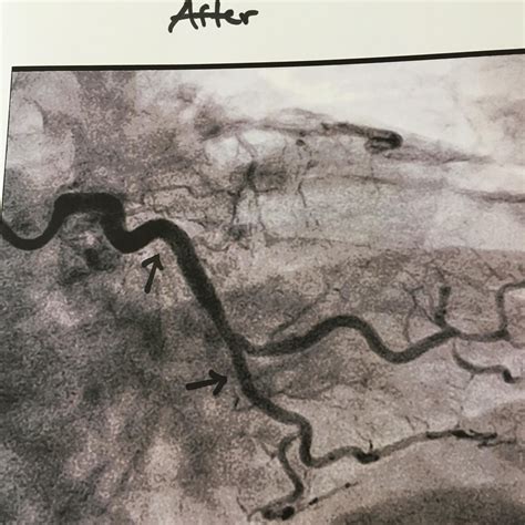 X Rays Of A Heart Before And After Placing Two Stents R