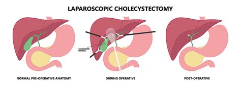 Routine Or Selective Cholangiography During Gallstone Surgery