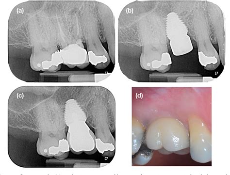 Figure From Contour Changes Following Immediate Placement Of Ultra