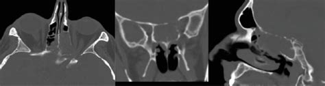 Retromaxillary Pneumatization Of Posterior Ethmoid Air 50 Off