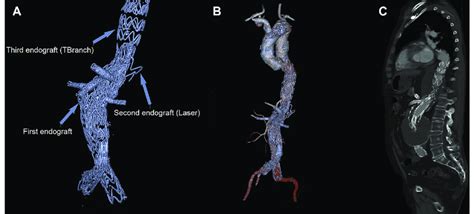 Computed tomography (CT) scan at 6-month follow-up after... | Download ...