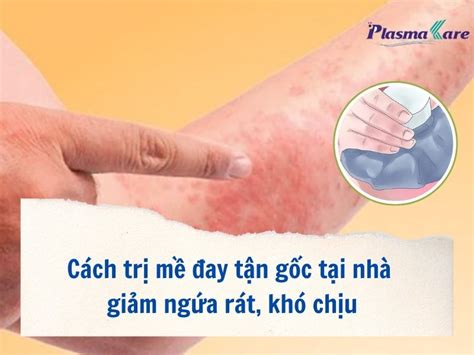 Cách Trị Mề đay Tận Gốc Giải Pháp Hiệu Quả Và An Toàn