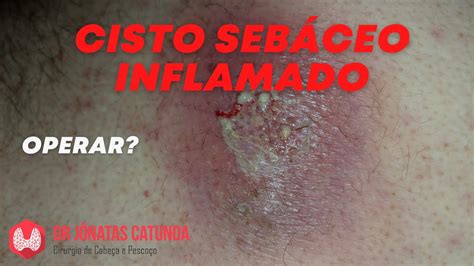 Cisto Seb Ceo Tratamento Cirurgia Ap S Desinflamar Youtube