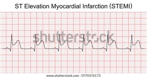 Electrocardiogram Show St Elevation Myocardial Infarction Stock Vector