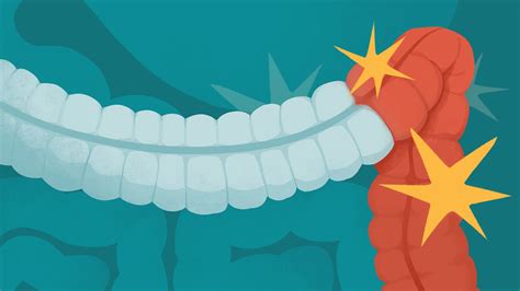 Understanding IBD